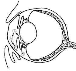 Glaucoma